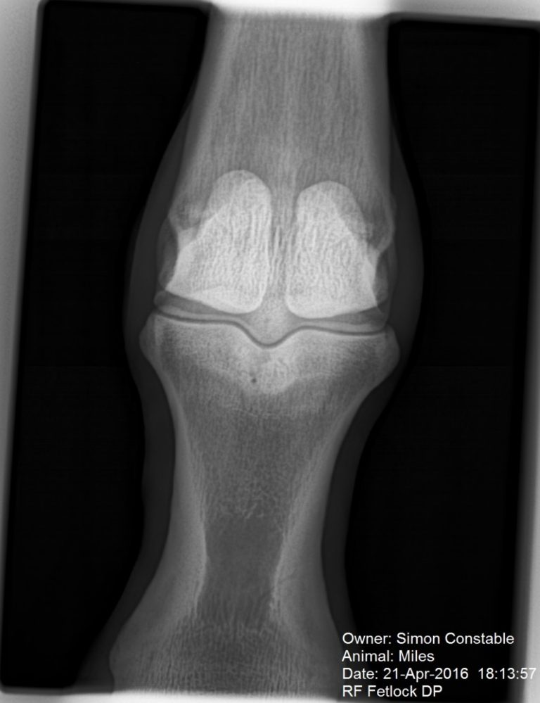 Bone Oedema